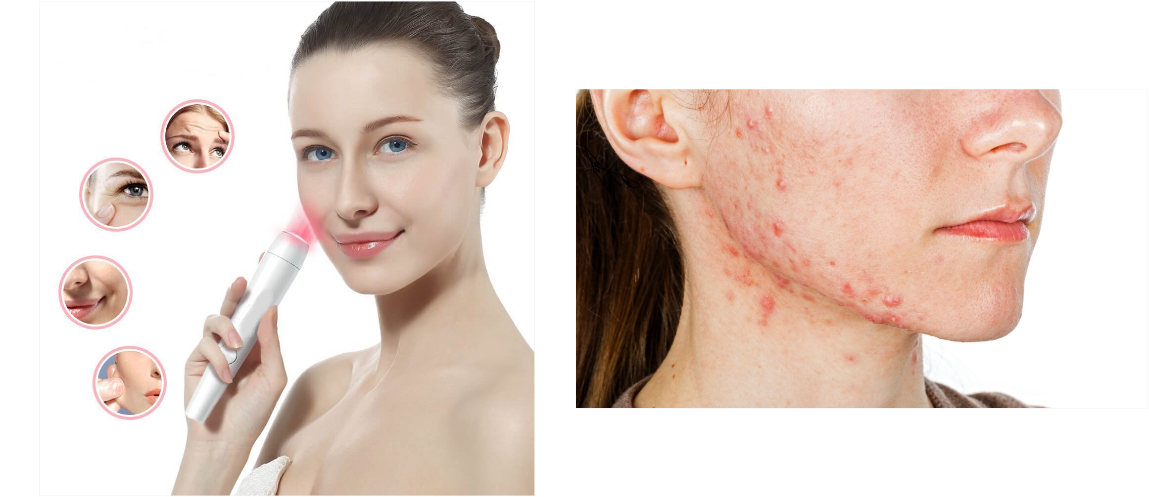 toallitas acne 119