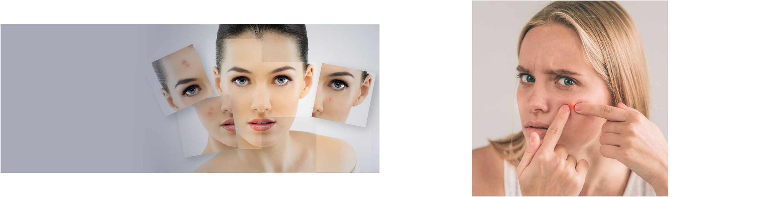 toallitas acne 131