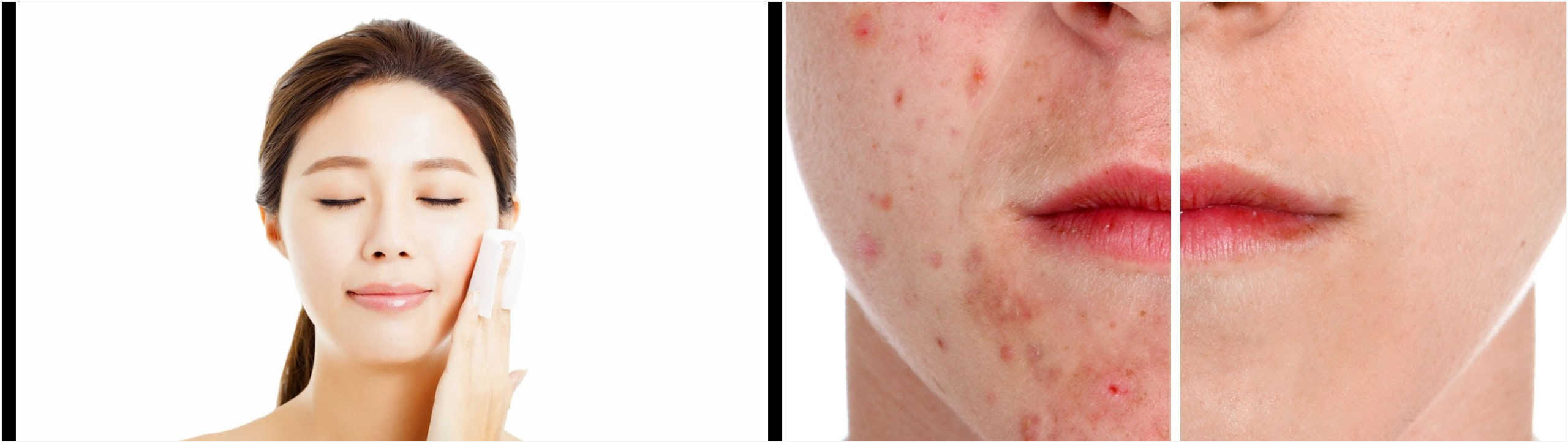toallitas acne 137