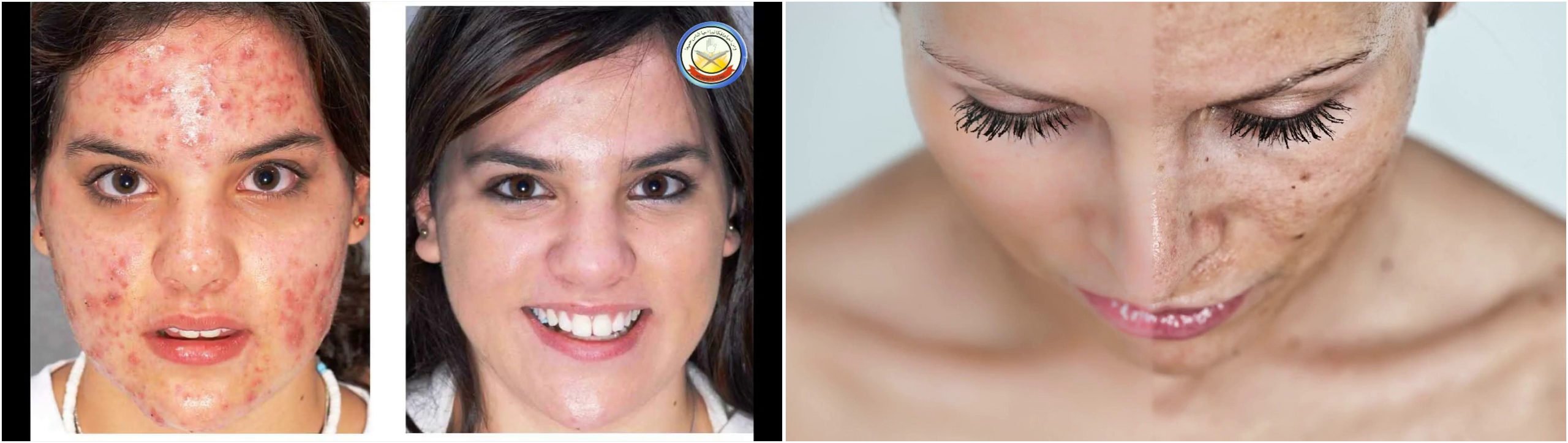 eridosis acne opiniones • Toallitas para el Acné: Guía Compra