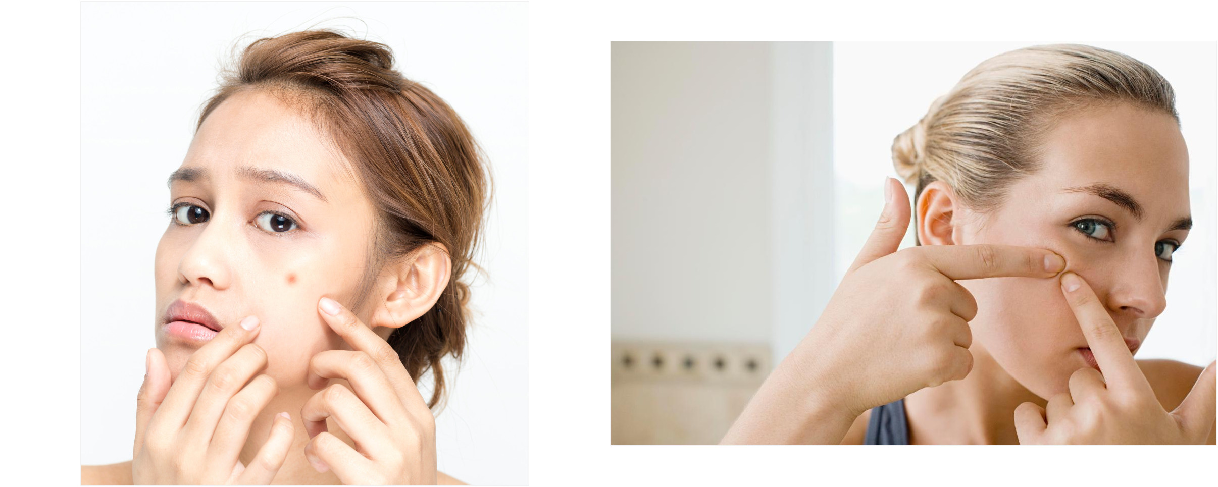 toallitas acne 175