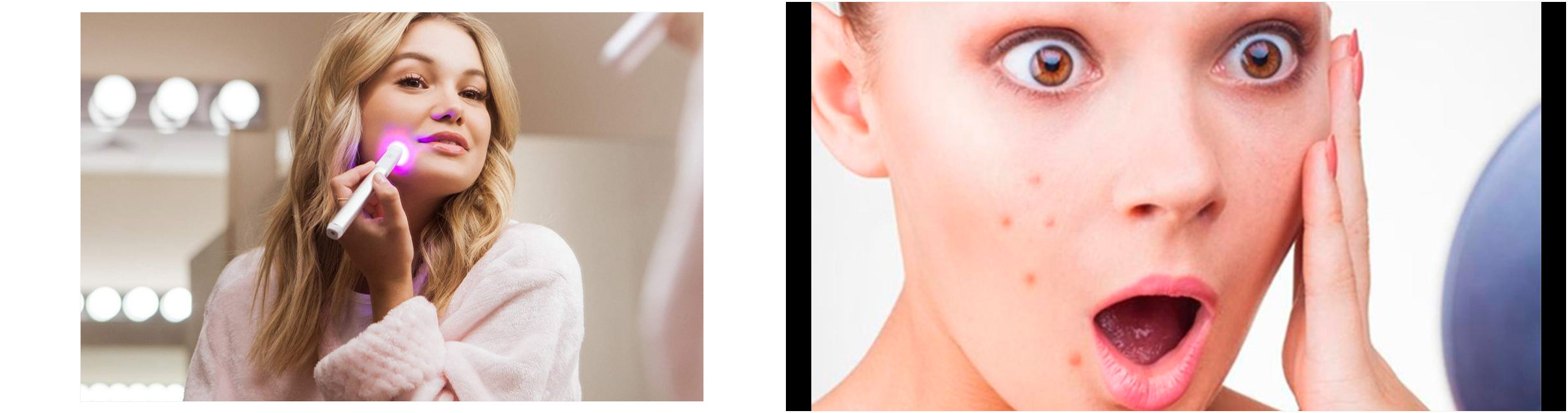 toallitas acne 181