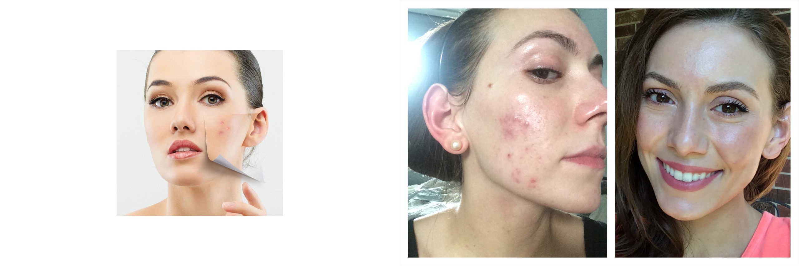 toallitas acne 187