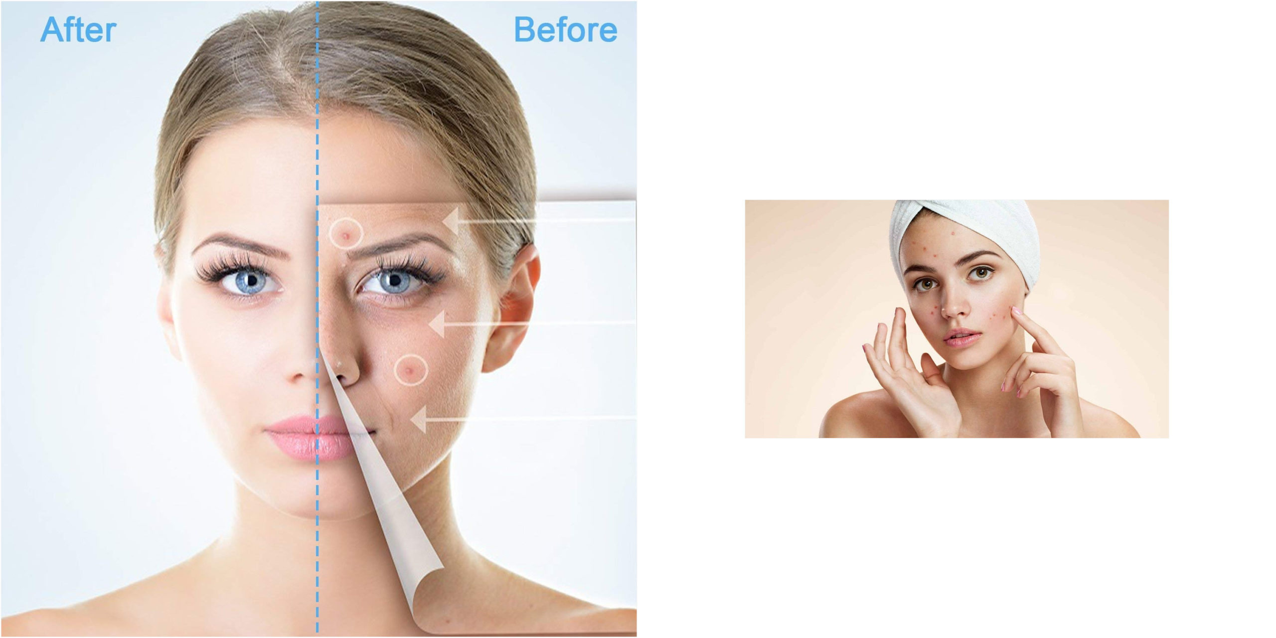 toallitas acne 191