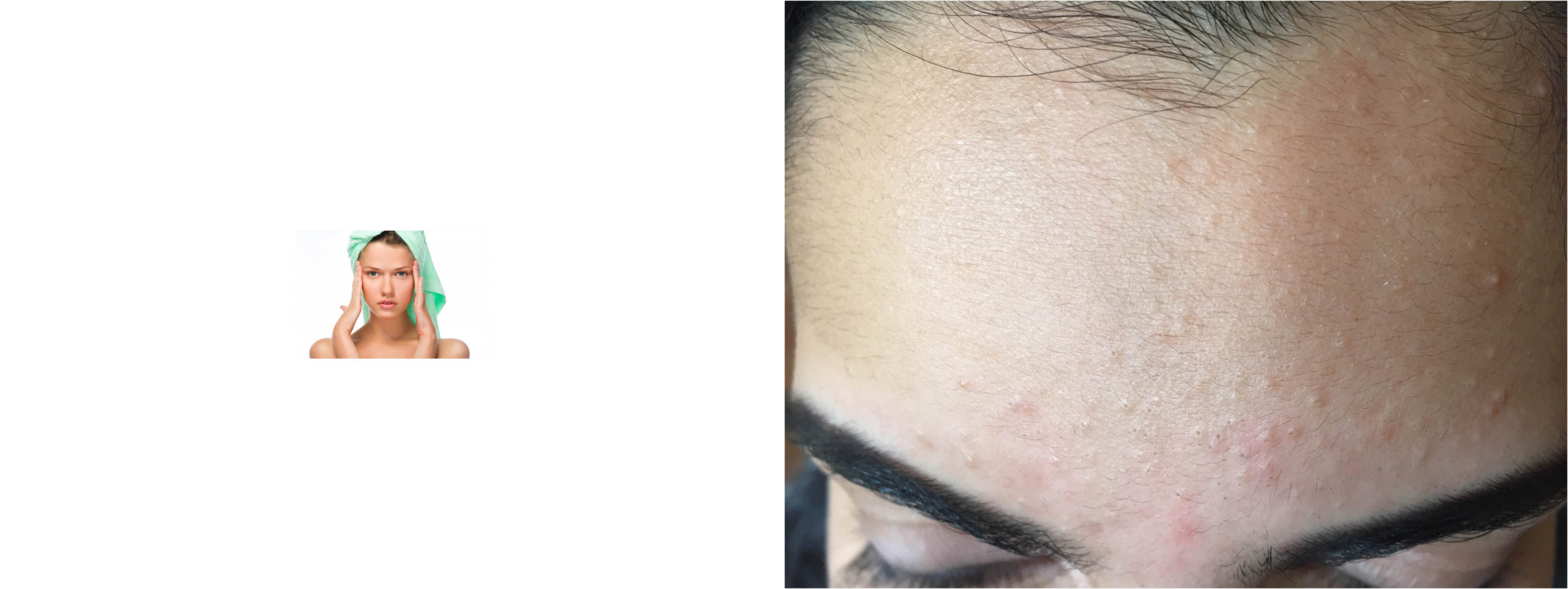 toallitas acne 197