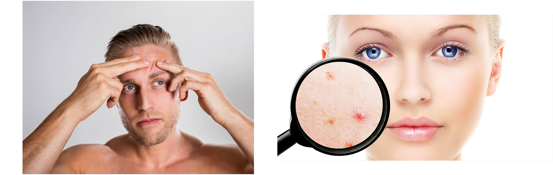 toallitas acne 213