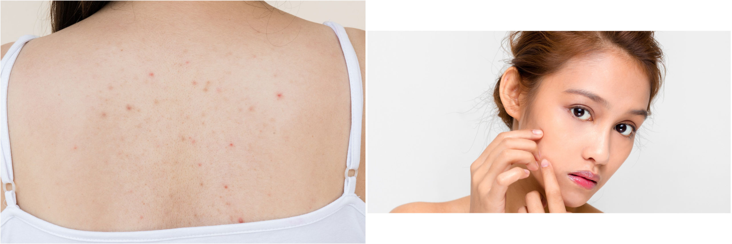 toallitas acne 25