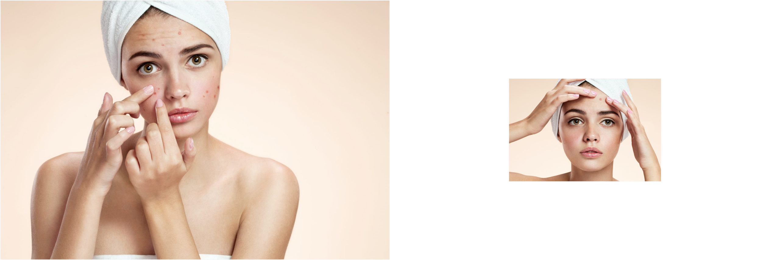 toallitas acne 37