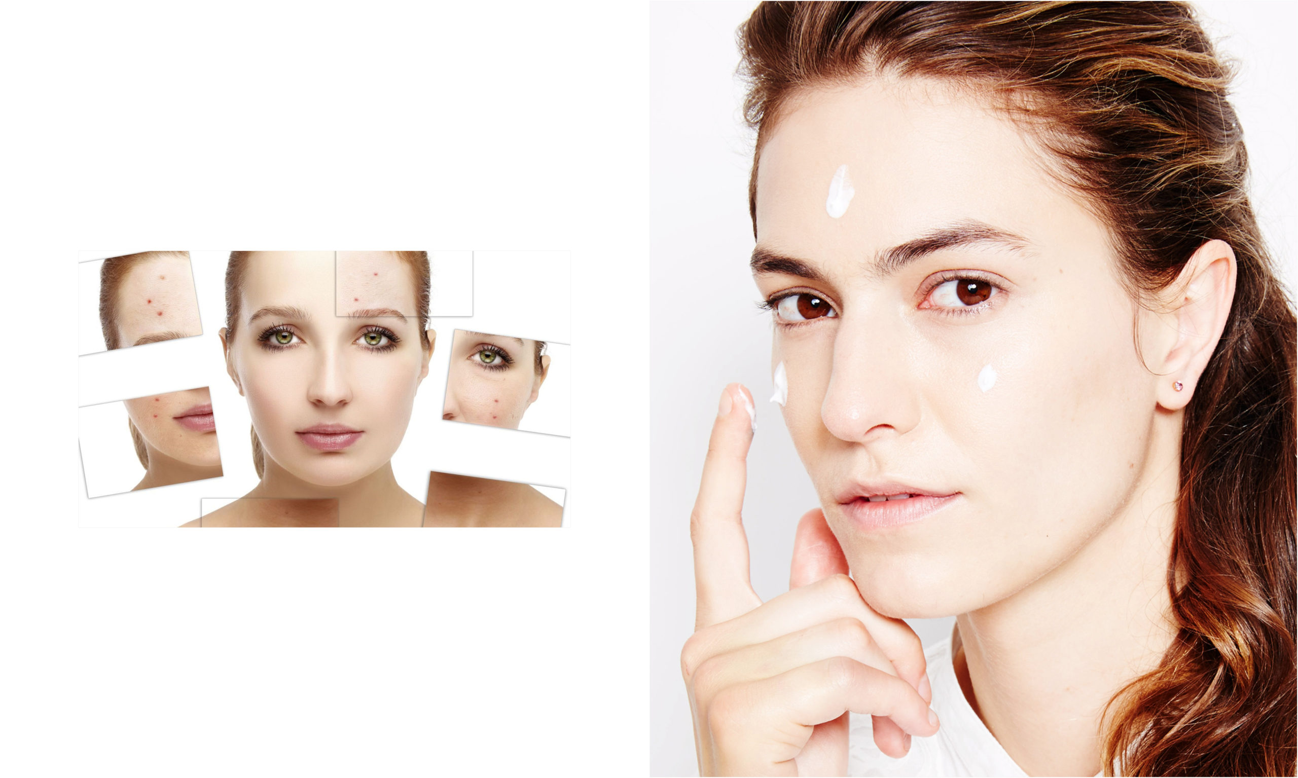 toallitas acne 61