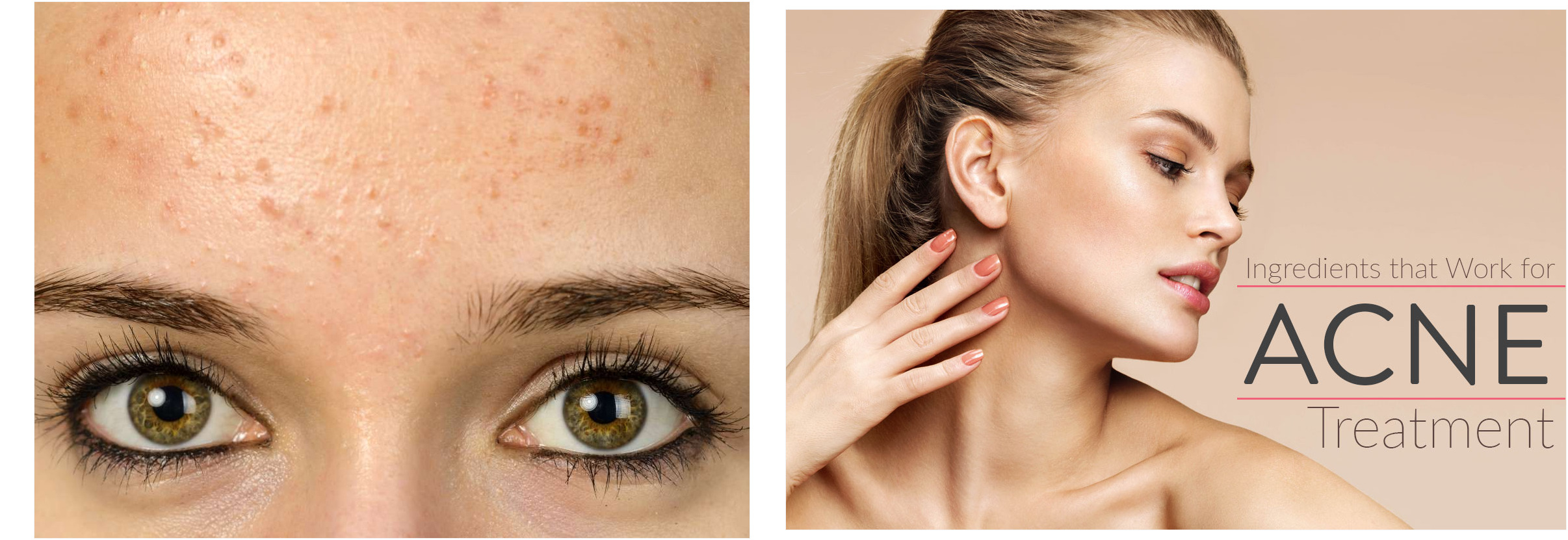toallitas acne 75
